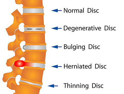 NSSD (Non surgical spine decompression)